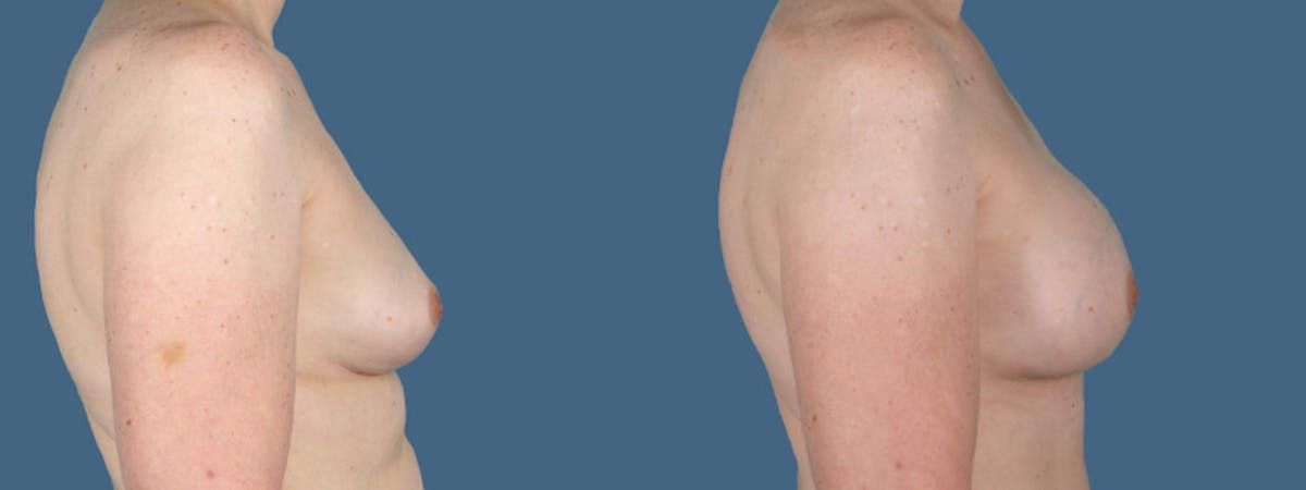 Direct to Implant Reconstruction Before & After Gallery - Patient 257224 - Image 2