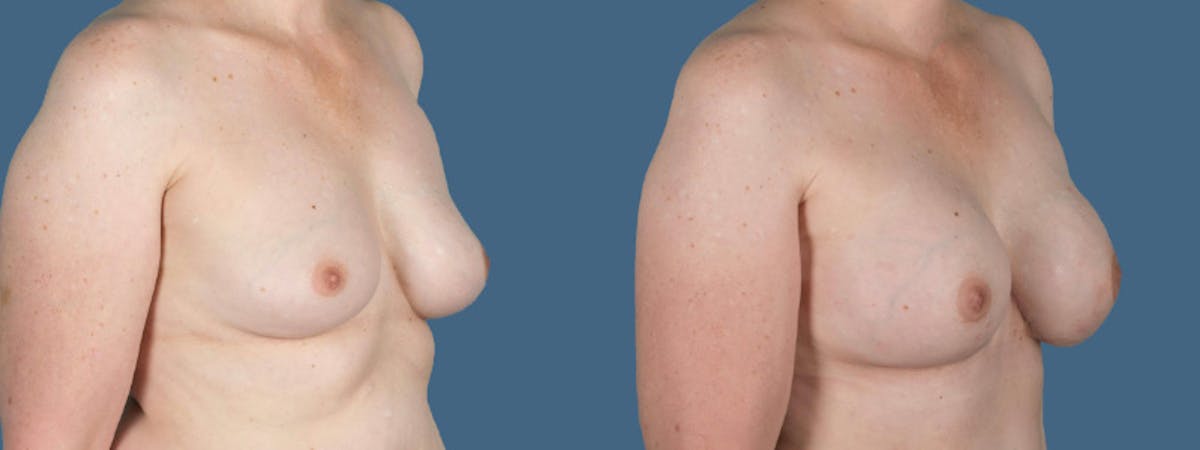 Direct to Implant Reconstruction Before & After Gallery - Patient 257224 - Image 3