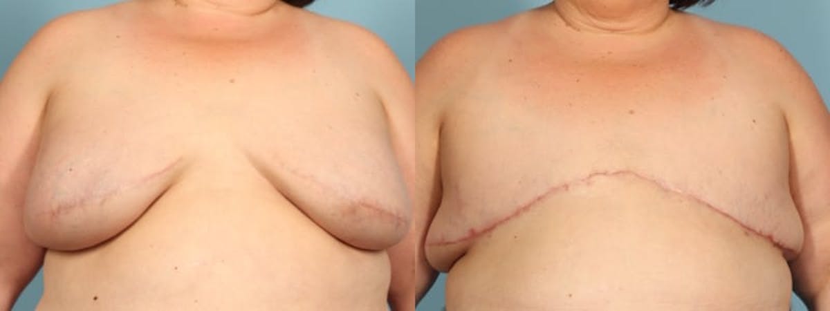 Mastectomy and Flat Before & After Gallery - Patient 105968 - Image 1