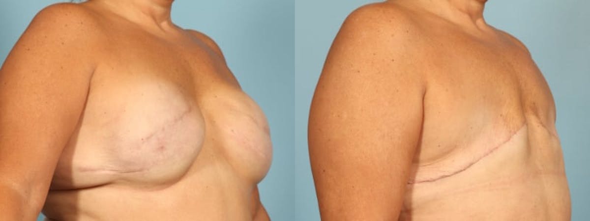 Mastectomy and Flat Before & After Gallery - Patient 344221 - Image 2