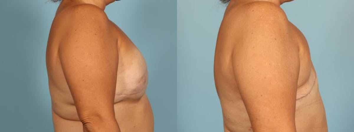 Mastectomy and Flat Before & After Gallery - Patient 344221 - Image 4