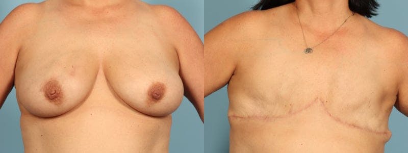 Mastectomy and Flat Before & After Gallery - Patient 225789 - Image 1