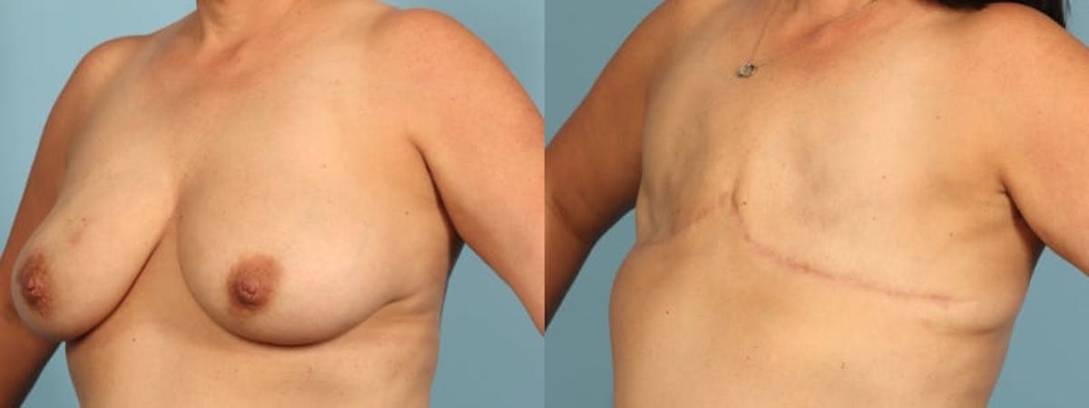 Mastectomy and Flat Before & After Gallery - Patient 225789 - Image 3
