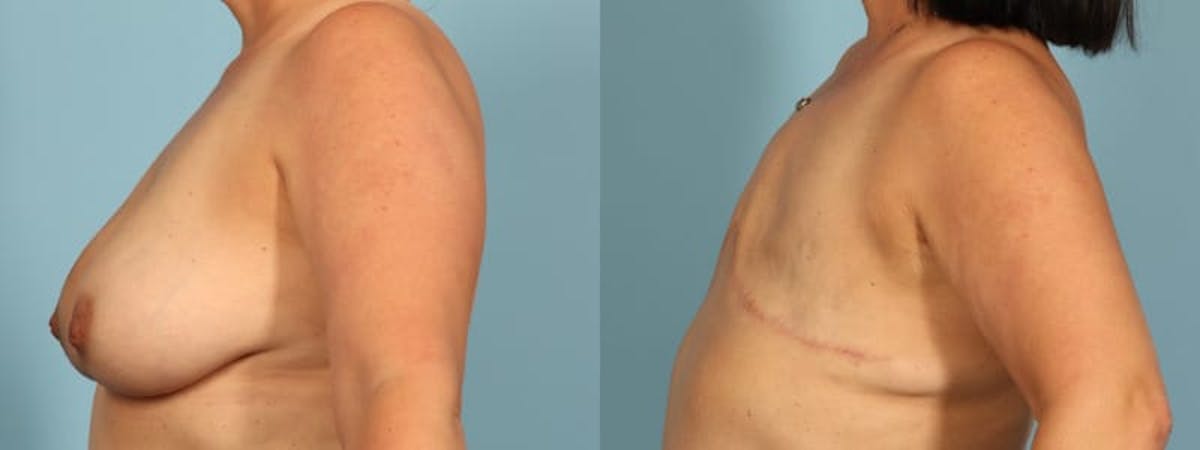 Mastectomy and Flat Before & After Gallery - Patient 225789 - Image 4