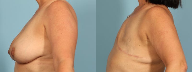 Mastectomy and Flat Before & After Gallery - Patient 225789 - Image 4