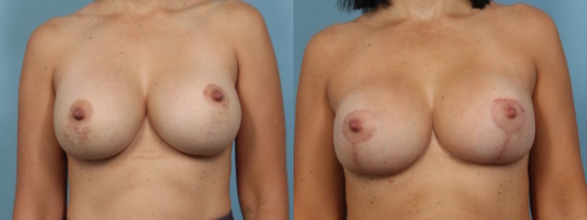 Implant Revision Before & After Gallery - Patient 239427 - Image 1