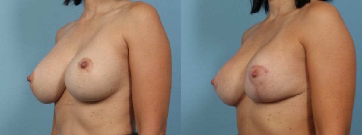 Implant Revision Before & After Gallery - Patient 239427 - Image 3