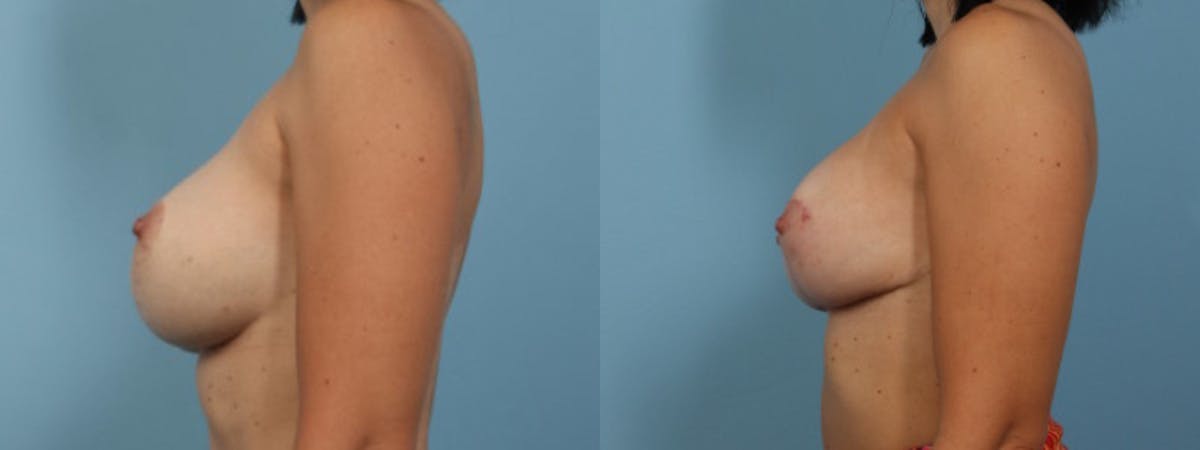 Implant Revision Before & After Gallery - Patient 239427 - Image 4