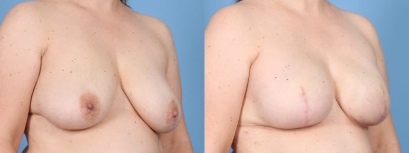 Direct to Implant Reconstruction Before & After Gallery - Patient 270247 - Image 2