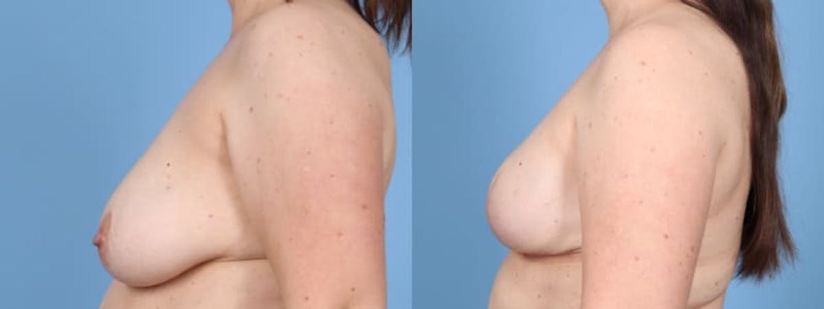 Direct to Implant Reconstruction Before & After Gallery - Patient 270247 - Image 4