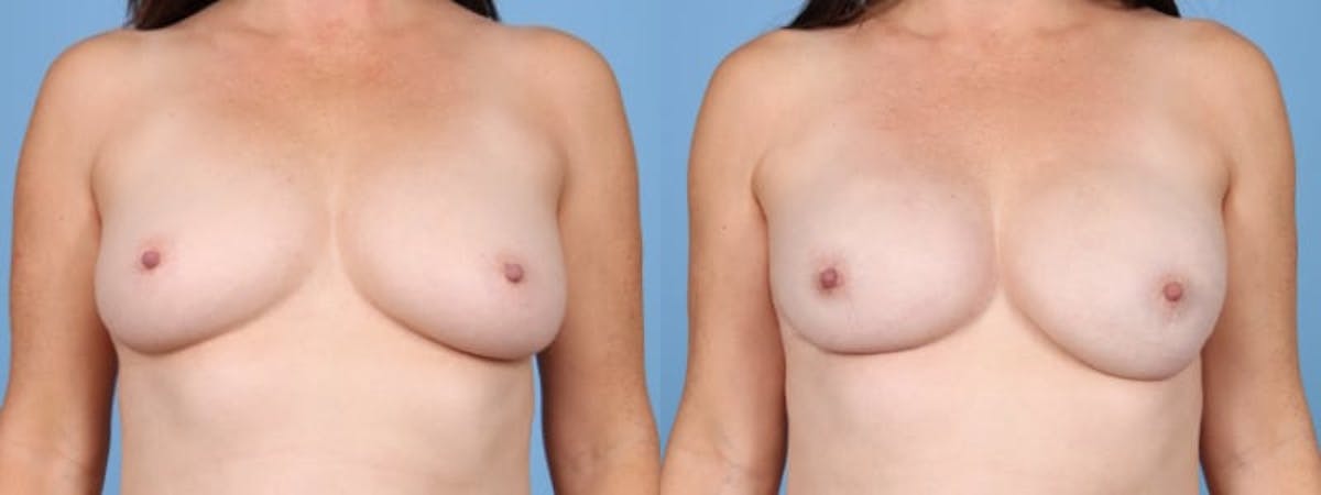 Direct to Implant Reconstruction Before & After Gallery - Patient 167435 - Image 1