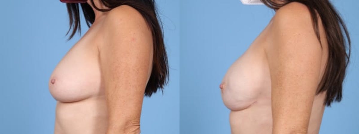 Direct to Implant Reconstruction Before & After Gallery - Patient 167435 - Image 5