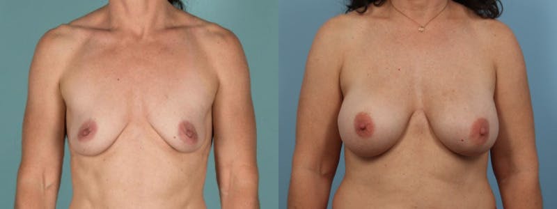 Direct to Implant Reconstruction Before & After Gallery - Patient 396061 - Image 1
