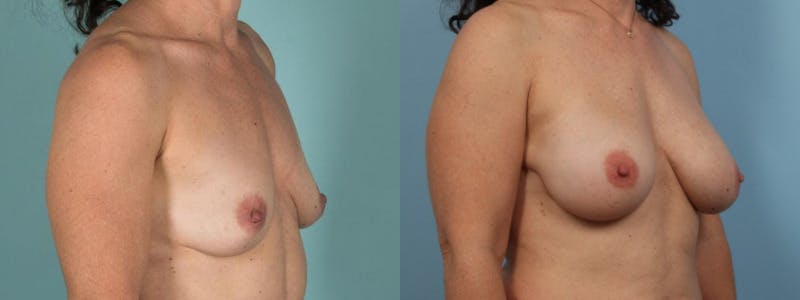Direct to Implant Reconstruction Before & After Gallery - Patient 396061 - Image 2
