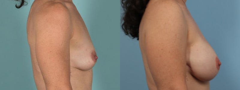 Direct to Implant Reconstruction Before & After Gallery - Patient 396061 - Image 3