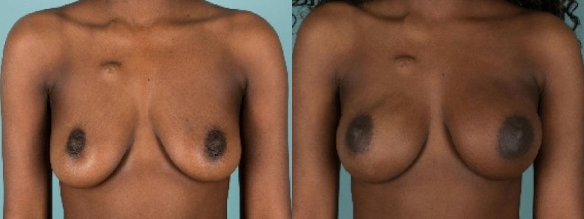 Direct to Implant Reconstruction Before & After Gallery - Patient 273598 - Image 2