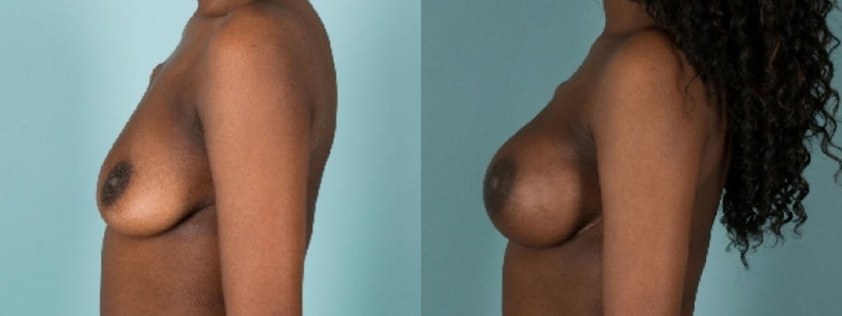 Direct to Implant Reconstruction Before & After Gallery - Patient 273598 - Image 3