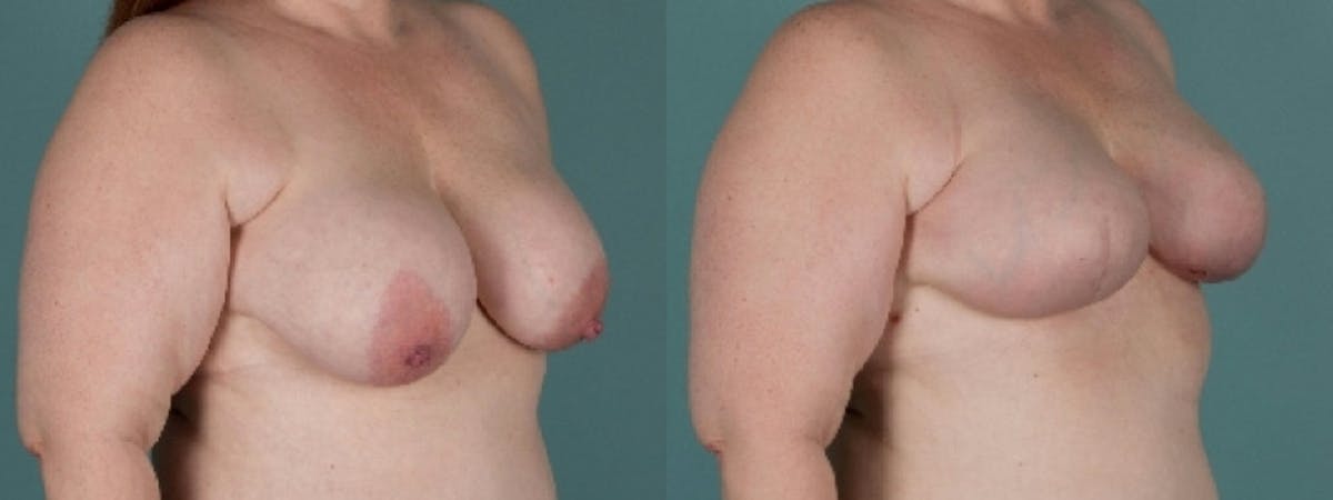 Direct to Implant Reconstruction Before & After Gallery - Patient 229153 - Image 1