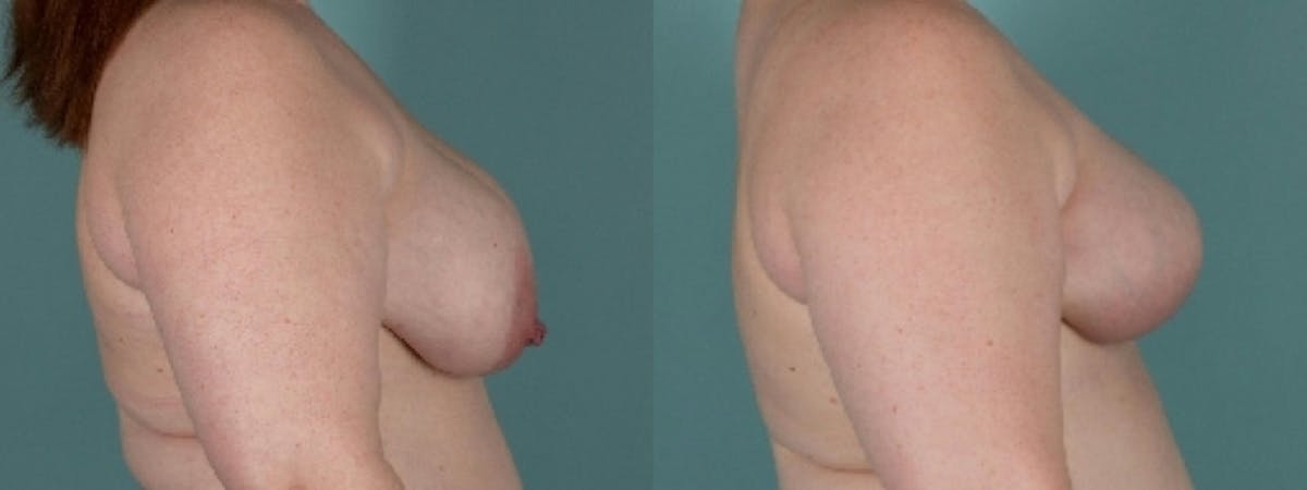 Direct to Implant Reconstruction Before & After Gallery - Patient 229153 - Image 3