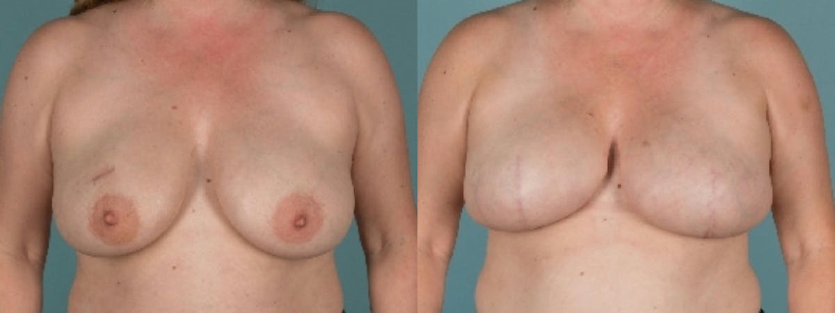 Direct to Implant Reconstruction Before & After Gallery - Patient 136496 - Image 2