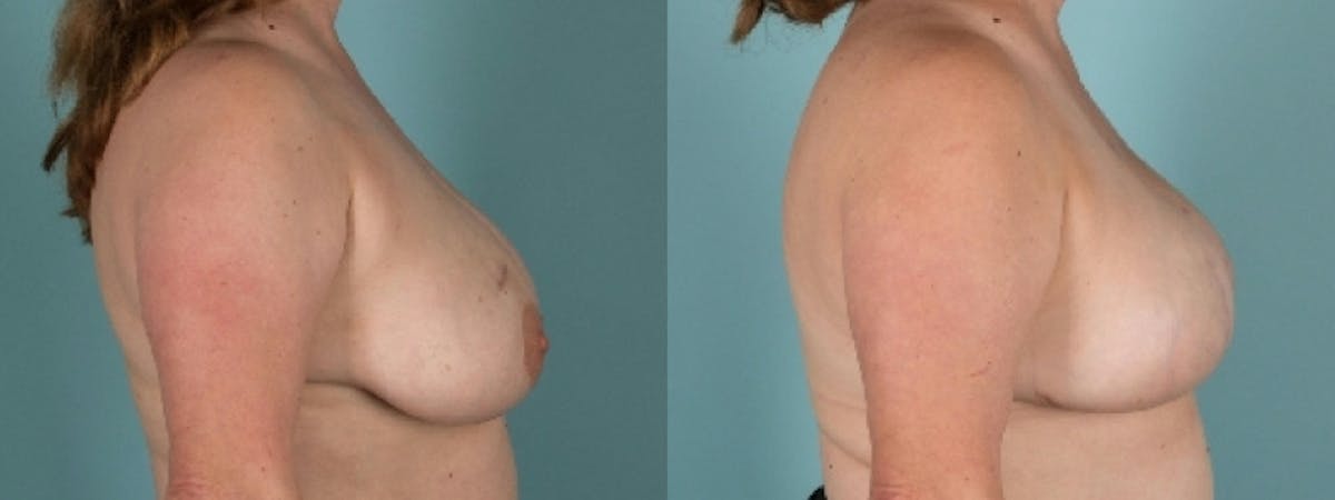 Direct to Implant Reconstruction Before & After Gallery - Patient 136496 - Image 3