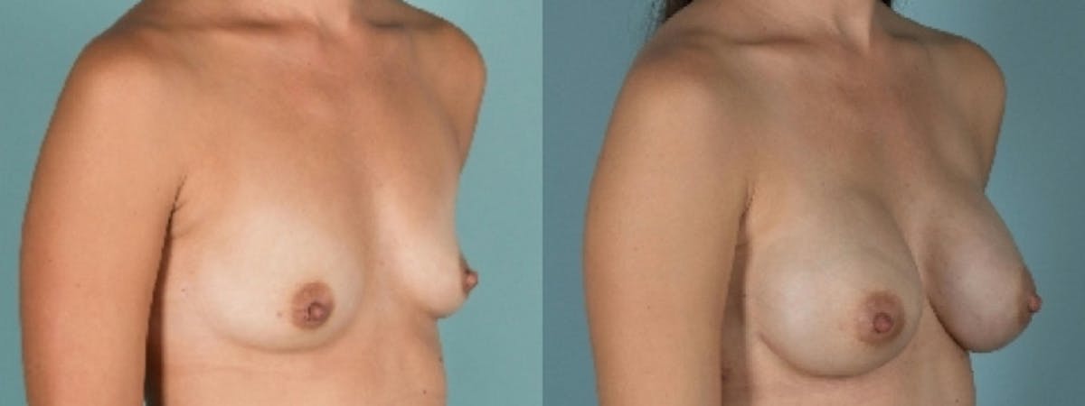 Direct to Implant Reconstruction Before & After Gallery - Patient 374764 - Image 1