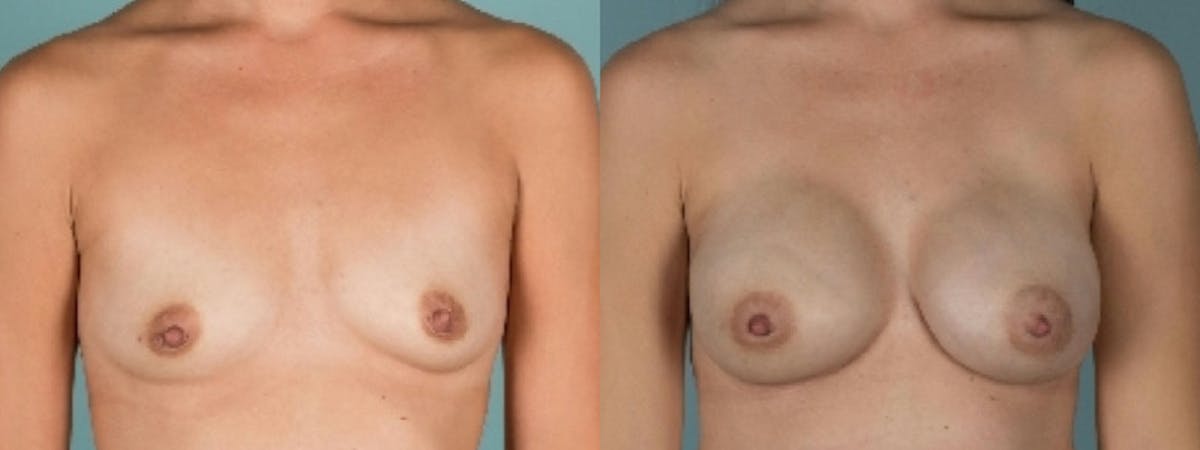 Direct to Implant Reconstruction Before & After Gallery - Patient 374764 - Image 2