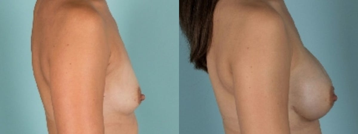 Direct to Implant Reconstruction Before & After Gallery - Patient 374764 - Image 3