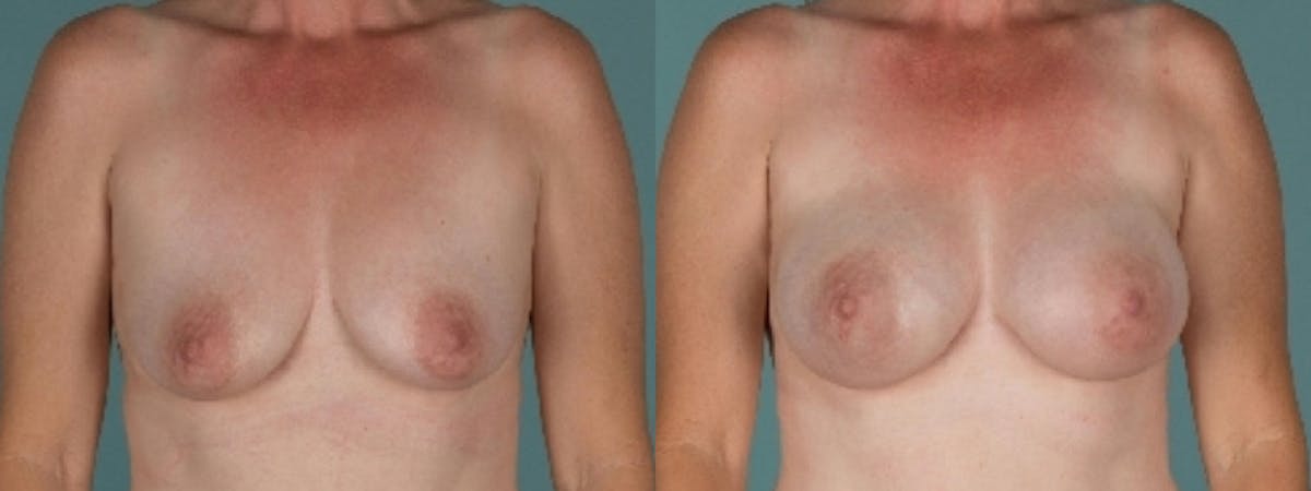 Direct to Implant Reconstruction Before & After Gallery - Patient 196834 - Image 1