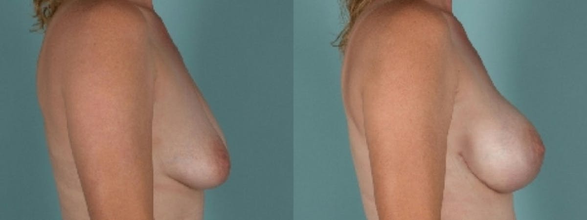 Direct to Implant Reconstruction Before & After Gallery - Patient 196834 - Image 3