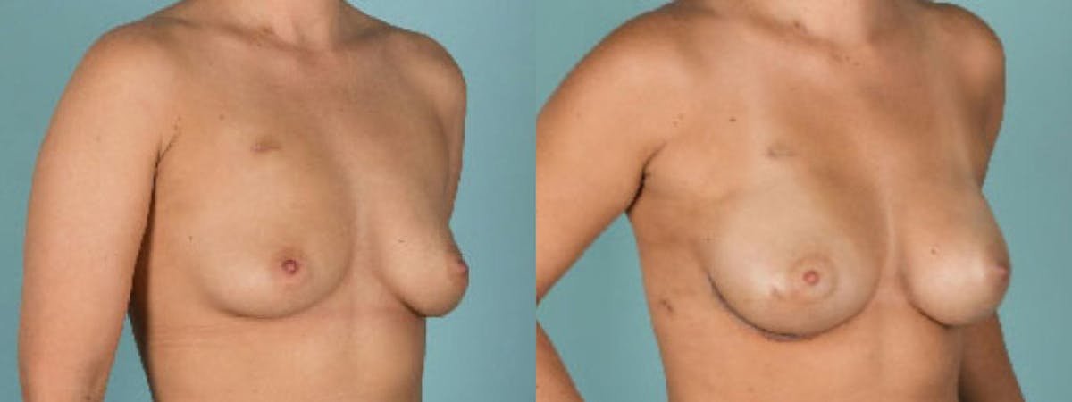 Direct to Implant Reconstruction Before & After Gallery - Patient 506433 - Image 1