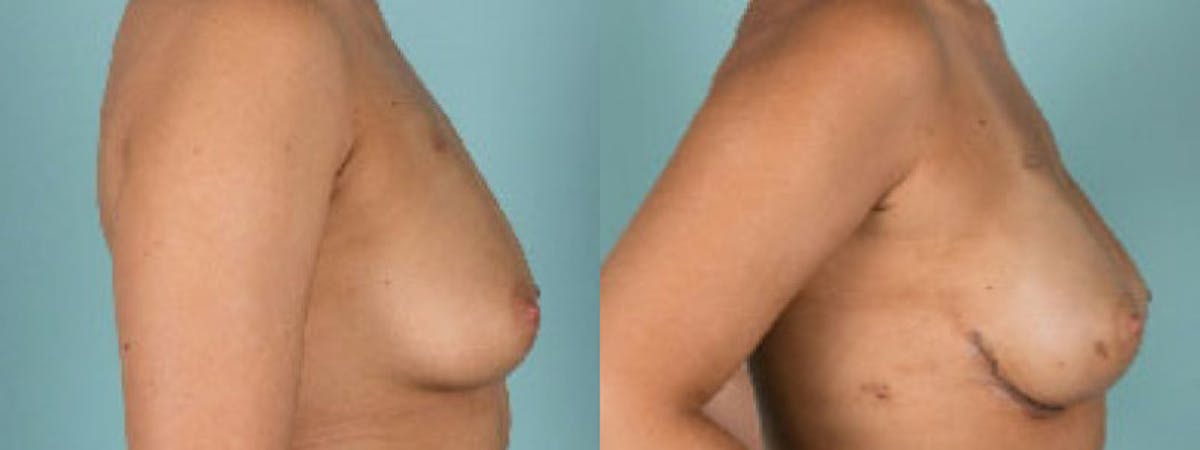 Direct to Implant Reconstruction Before & After Gallery - Patient 506433 - Image 3