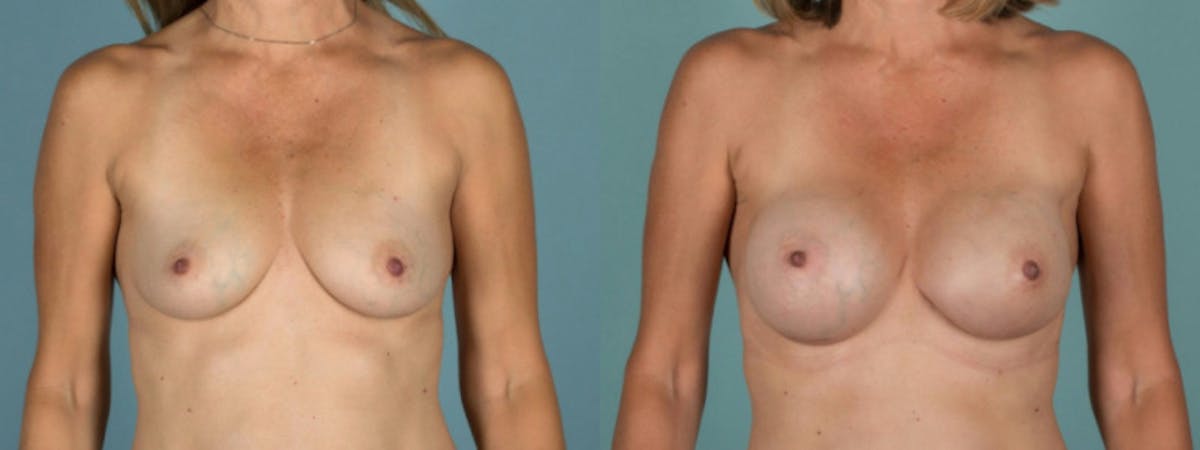 Direct to Implant Reconstruction Before & After Gallery - Patient 193462 - Image 1