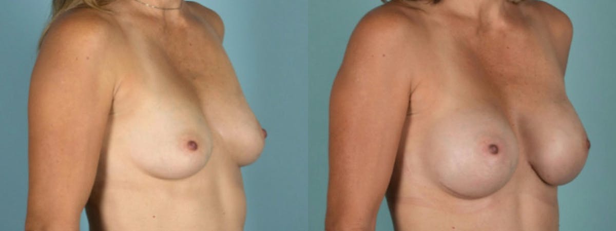 Direct to Implant Reconstruction Before & After Gallery - Patient 193462 - Image 3
