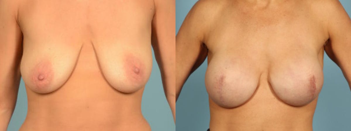 Direct to Implant Reconstruction Before & After Gallery - Patient 272427 - Image 1