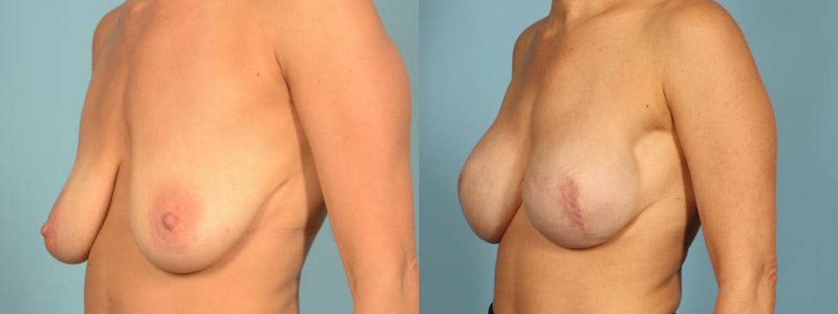 Direct to Implant Reconstruction Before & After Gallery - Patient 272427 - Image 2