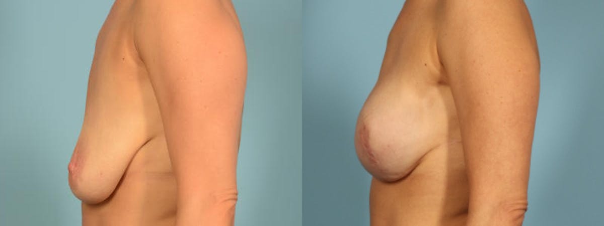 Direct to Implant Reconstruction Before & After Gallery - Patient 272427 - Image 4