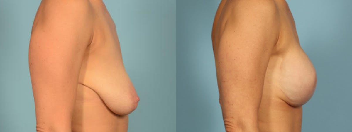 Direct to Implant Reconstruction Before & After Gallery - Patient 272427 - Image 5