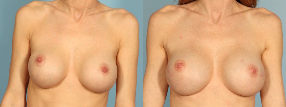 Direct to Implant Reconstruction Before & After Gallery - Patient 301343 - Image 1