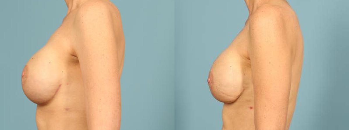 Direct to Implant Reconstruction Before & After Gallery - Patient 713202 - Image 4