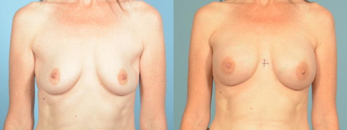 Direct to Implant Reconstruction Before & After Gallery - Patient 151387 - Image 1