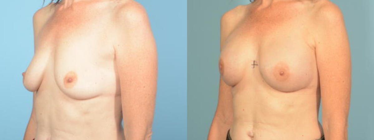 Direct to Implant Reconstruction Before & After Gallery - Patient 151387 - Image 2