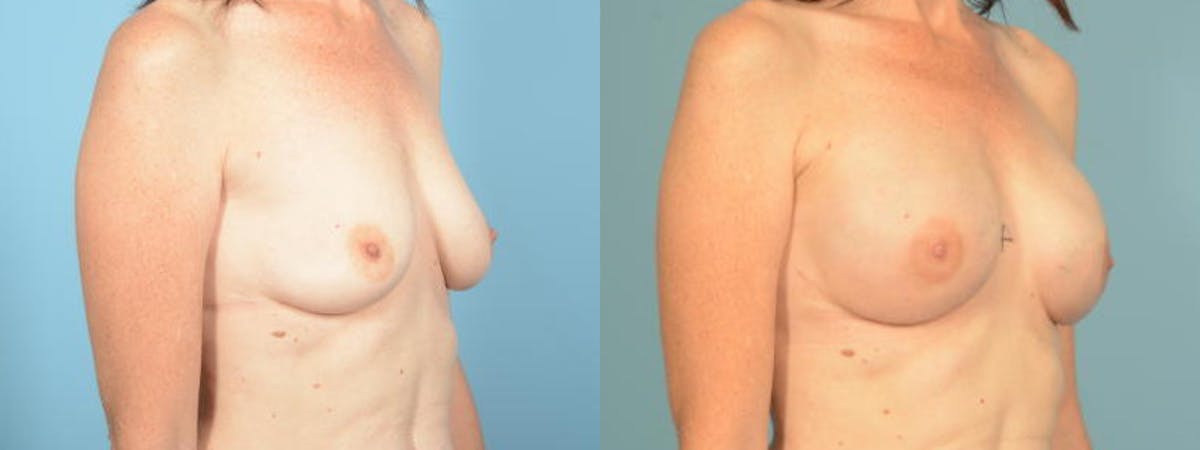 Direct to Implant Reconstruction Before & After Gallery - Patient 151387 - Image 3