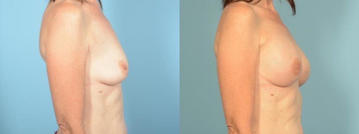 Direct to Implant Reconstruction Before & After Gallery - Patient 151387 - Image 5
