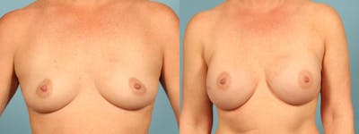 Direct to Implant Reconstruction Before & After Gallery - Patient 267739 - Image 1