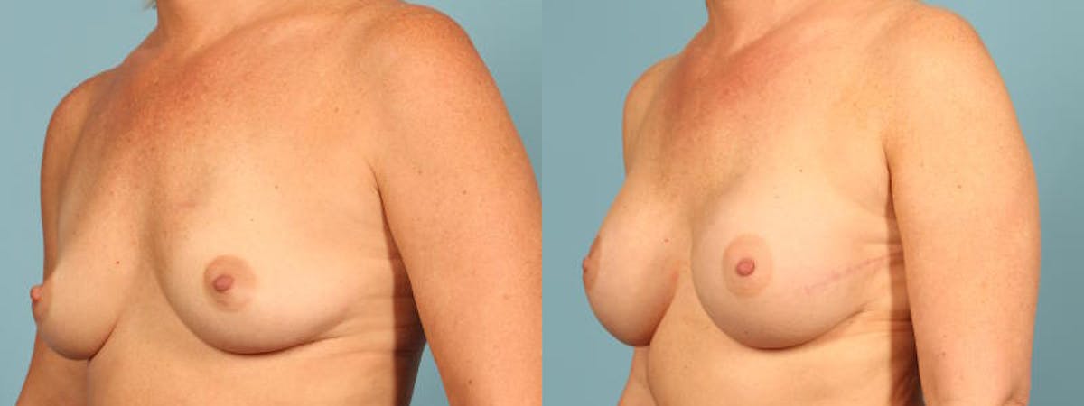 Direct to Implant Reconstruction Before & After Gallery - Patient 267739 - Image 2