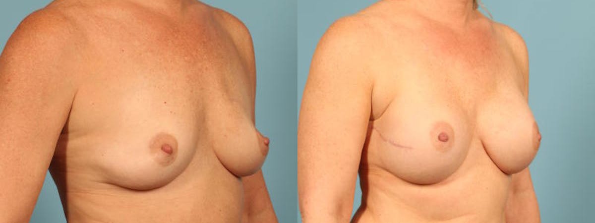 Direct to Implant Reconstruction Before & After Gallery - Patient 267739 - Image 3