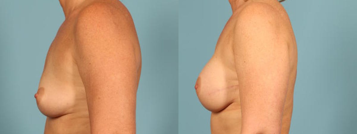 Direct to Implant Reconstruction Before & After Gallery - Patient 267739 - Image 4