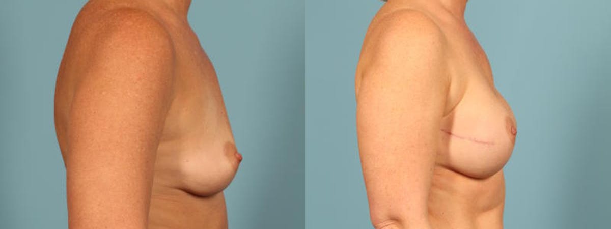 Direct to Implant Reconstruction Before & After Gallery - Patient 267739 - Image 5