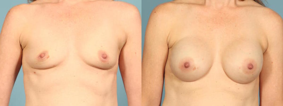 Direct to Implant Reconstruction Before & After Gallery - Patient 325390 - Image 1